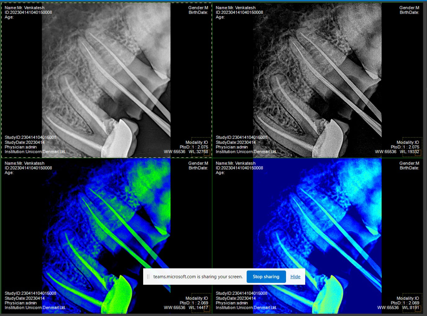 Xpect Vision Intraoral Sensor - Vitalticks PVT LTD