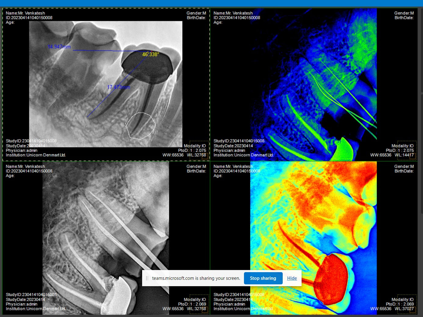 Xpect Vision Intraoral Sensor - Vitalticks PVT LTD