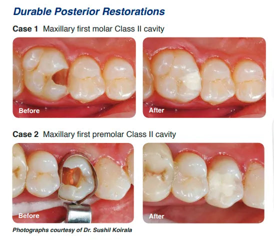 Shofu Zirconomer Improved - Vitalticks PVT LTD